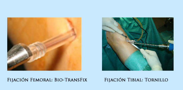 Cirugía del LCA de Rodilla: Ligamentoplastia