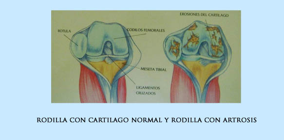 Artrosis de rodilla: nuestra plataforma vibratoria ayuda a su recuperación