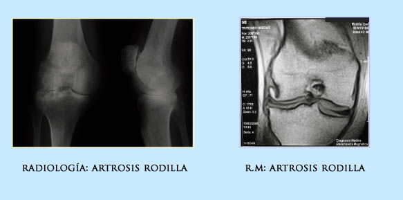 Artrosis de rodilla  Doctor Javier Vaquero Ruipérez