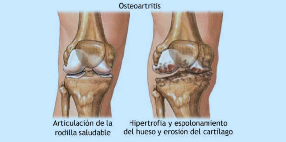 Artrosis en rodillas