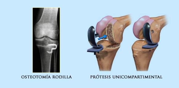 Artrosis de rodilla  Doctor Javier Vaquero Ruipérez