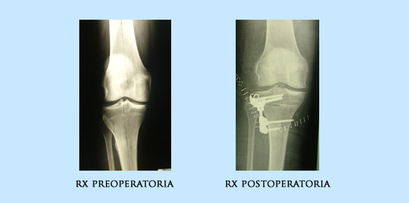 Osteotomia de rodilla