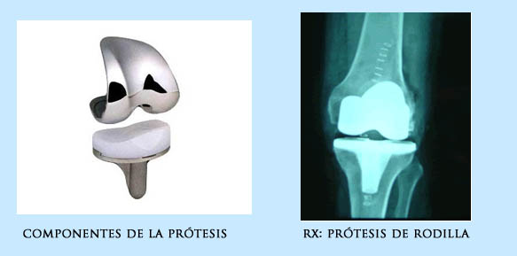 Prótesis total de rodilla  Doctor Javier Vaquero Ruipérez